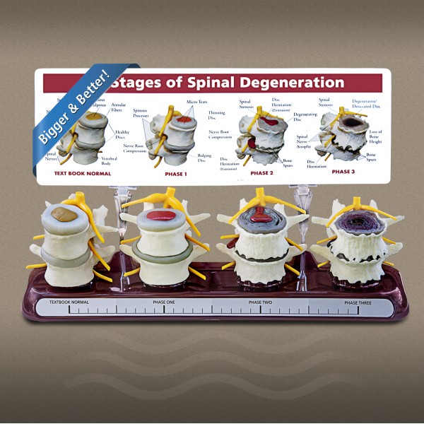4 Stage Spine Degeneration Model - Out of Stock! - Please call to be placed on Reserved List