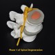 4 Stage Spine Degeneration Model
