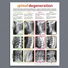 Handout - Spinal Degeneration
